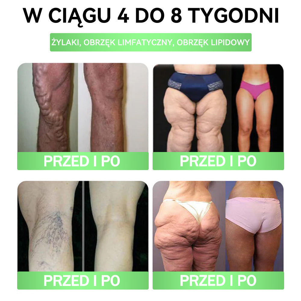 🎀ANGELTRAP® Moringa × Berberyna × AMPK 10-w-1 Wsparcie metaboliczne, plaster z nanotechnologią mikroigłową 🇵🇱(Wystarczy raz dziennie, widoczne efekty w 7 dni) ✅ Na otyłość, wiotką skórę, cukrzycę, bezdech senny, problemy ze stawami i wiele innych